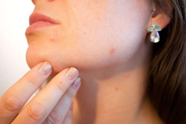 How to Get Rid of Acne Naturally: